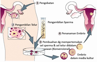 Kesuburan Bisakah seorang wanita yang sudah menopause 