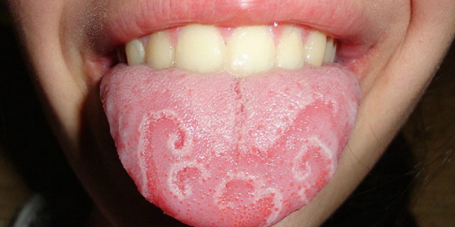 Penyakit geographic tongue