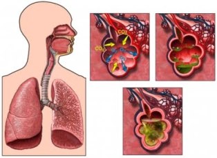 Dengan oleh atau yang penyakit dan paru-paru virus disebabkan terjadinya infeksi pada bakteri menyebabkan alveolus radang disebut 13 penyakit