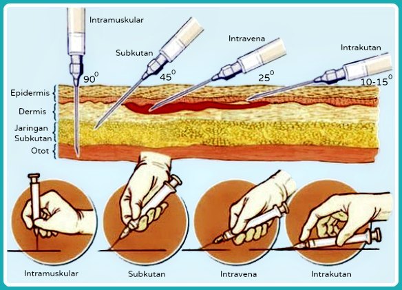 Apa perbedaan utama antara injeksi IV dan IM Galena